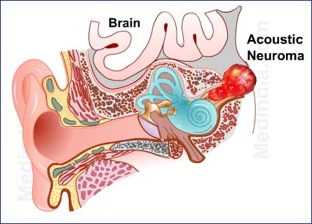 004 Acoustic-Neuroma