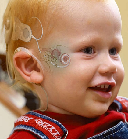 Cochlear-Implant-Diagram-Boy